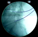 X-ray L4-L5 and L5-S1