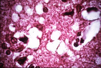 TSE infected brain