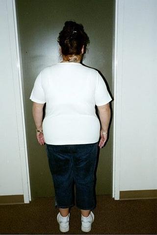 238-lbs Pre-op