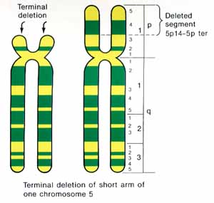 cri du chat chromosome abnormality cri du chat chromosome abnormality