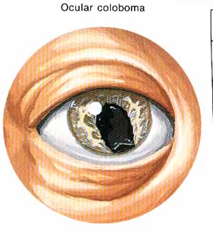 coloboma.jpg (23437 bytes)