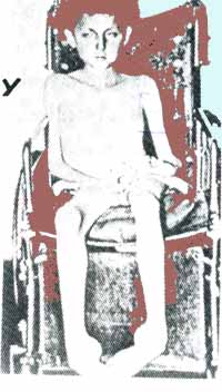 duchenne.jpg (21746 bytes)