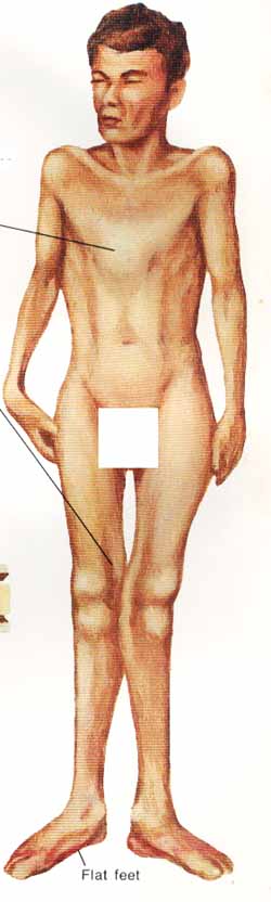 homocystin3.jpg (27692 bytes)