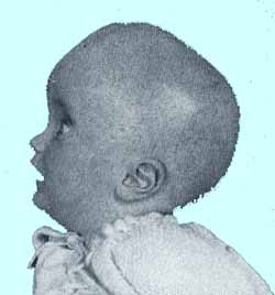 hydrocephalus.jpg (14265 bytes)