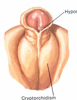 hypospadias.jpg (15774 bytes)