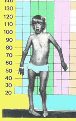 marfan.jpg (20407 bytes)