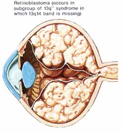 retinobl.jpg (21972 bytes)