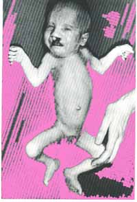 trisomy13.jpg (17661 bytes)