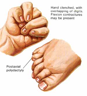 trisomy13b.jpg (20303 bytes)