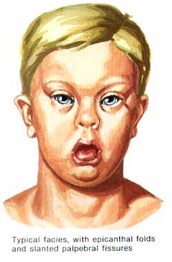 trisomy21.jpg (20744 bytes)