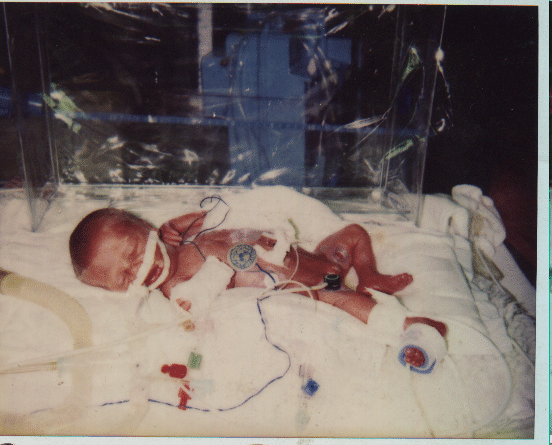 Emily on Day 1 of Life