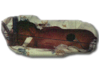 Katie at Birth