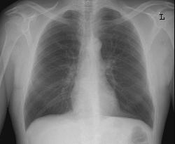 chest