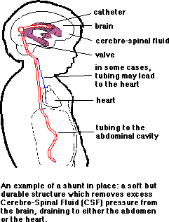 An example of a shunt in place