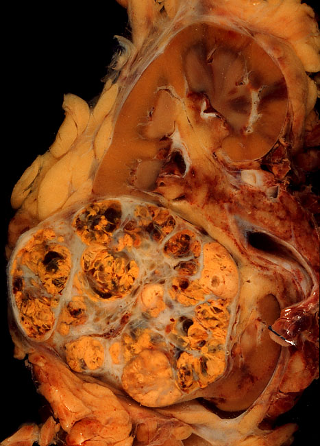 renal cell carcinoma