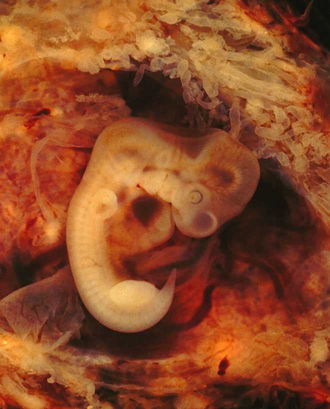 tubal pregnancy