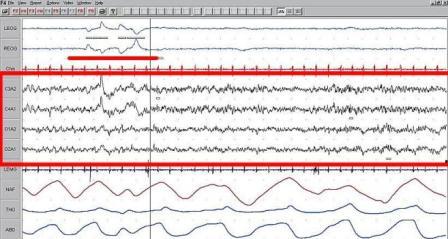 Slika sa mozdanim valovima.
