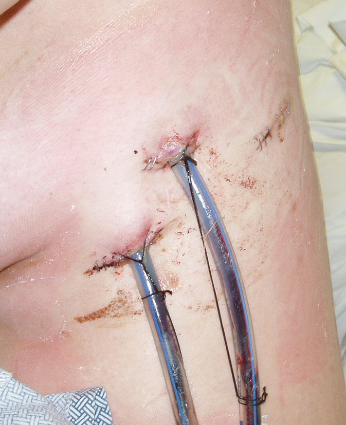 Chest tubes