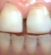 Diastema