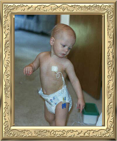 Logan's central hickman line (age 13 months)