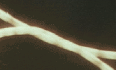 Closeup of the cord anomaly wrapping around itself.