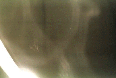 Heavy ectoplasm along with an unidentified item.
