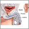 Prostatectomy- series