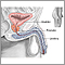 TURP- series