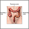 Large bowel resection- series