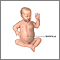 Umbilical hernia repair- series