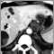 Liver echinococcus - CT scan