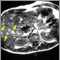 Melanoma of the liver -&#160;MRI scan