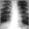 Sarcoid, stage II - chest X-ray