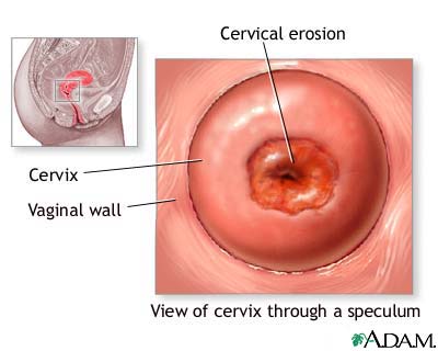 Cervical erosion