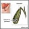 Cholelithiasis
