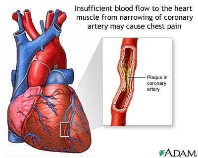 Angina