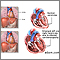 Alcoholic cardiomyopathy