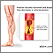 Arteriosclerosis of the extremities