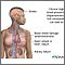 Untreated hypertension