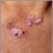 Lupus, discoid- view of lesions on the chest