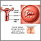 Cervical cancer