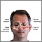 Chronic sinusitis