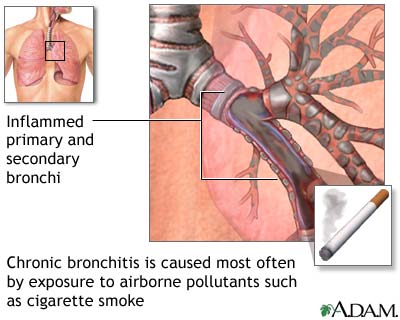 Cause of Chronic Bronchitis