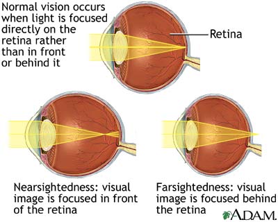 Normal, near, and farsightedness Normal, near, and farsightedness