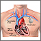Pacemaker