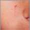 Tuberous sclerosis, angiofibromas- face