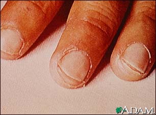 Kawasaki's disease, peeling of the fingertips