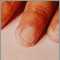 Kawasaki's disease, peeling of the fingertips