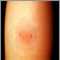 Positive ppd skin test