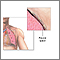 Chest tube insertion- series